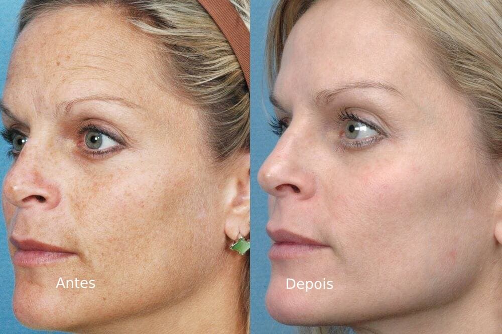 Fotorejuvenescimento-ipl-luz -pulsada-intensa-antes-depois